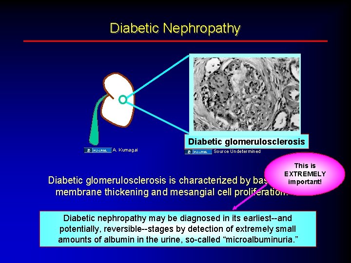 Diabetic Nephropathy Diabetic glomerulosclerosis A. Kumagai Source Undetermined This is EXTREMELY basement important! Diabetic