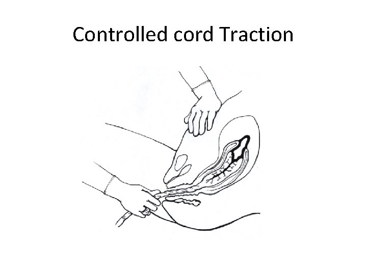 Controlled cord Traction Controlled cord Traction