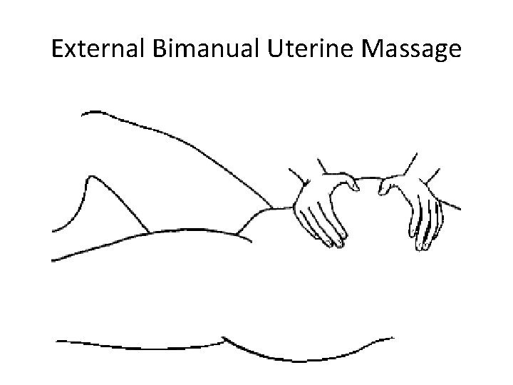 External Bimanual Uterine Massage External Bimanual Uterine Massage