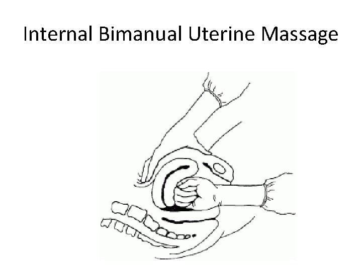 Internal Bimanual Uterine Massage Internal Bimanual Uterine Massage
