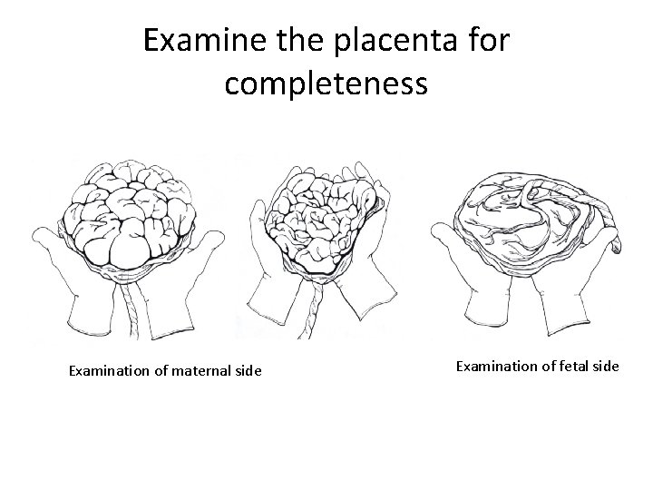Examine the placenta for completeness Examination of maternal side Examination of fetal side Examine the placenta for completeness Examination of maternal side Examination of fetal side