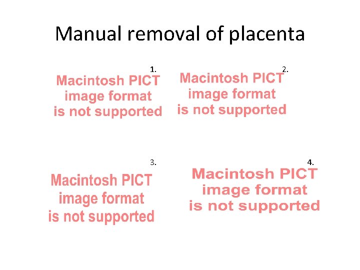 Manual removal of placenta 1. 3. 2. 4. Manual removal of placenta 1. 3. 2. 4.