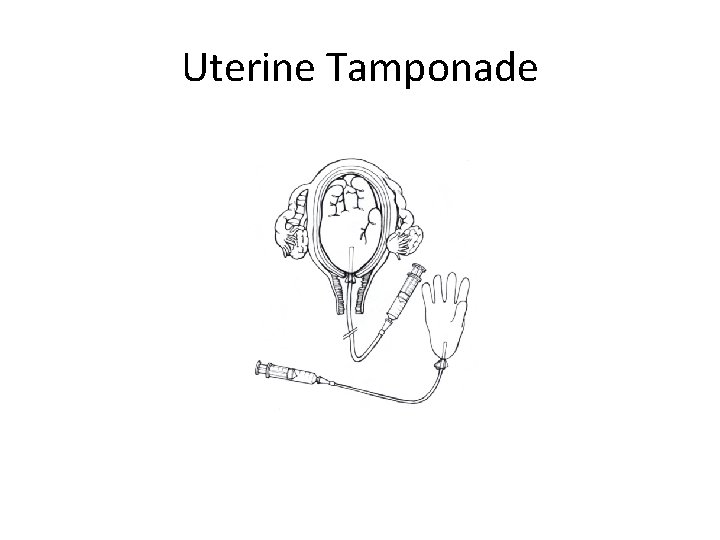 Uterine Tamponade Uterine Tamponade