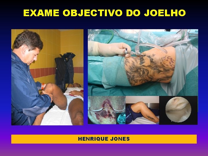 EXAME OBJECTIVO DO JOELHO HENRIQUE JONES 