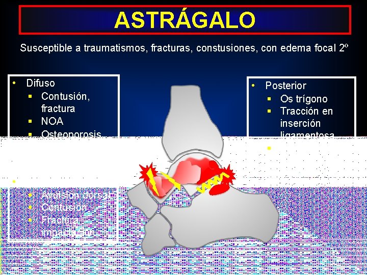 ASTRÁGALO Susceptible a traumatismos, fracturas, constusiones, con edema focal 2º • Difuso § Contusión,