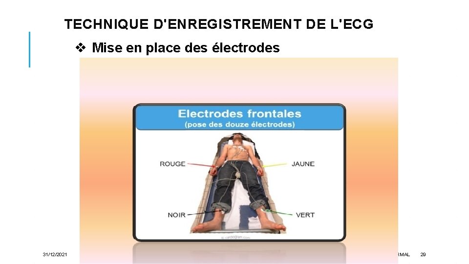 TECHNIQUE D'ENREGISTREMENT DE L'ECG v Mise en place des électrodes 31/12/2021 ELECTROCARDIOGRAMME NORMAL 29