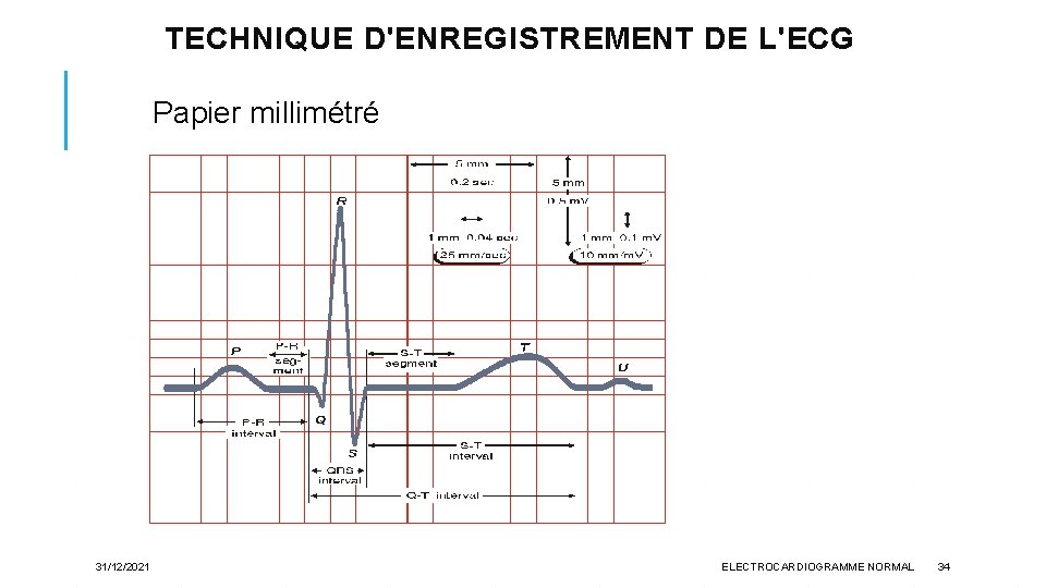 TECHNIQUE D'ENREGISTREMENT DE L'ECG Papier millimétré 31/12/2021 ELECTROCARDIOGRAMME NORMAL 34 