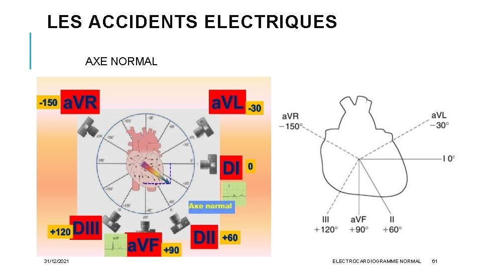 LES ACCIDENTS ELECTRIQUES AXE NORMAL 31/12/2021 ELECTROCARDIOGRAMME NORMAL 61 