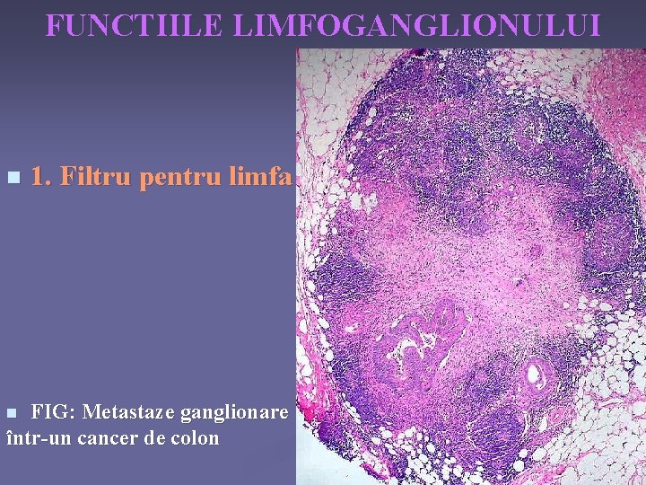 FUNCTIILE LIMFOGANGLIONULUI n 1. Filtru pentru limfa FIG: Metastaze ganglionare într-un cancer de colon