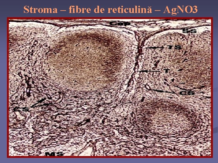 Stroma – fibre de reticulină – Ag. NO 3 
