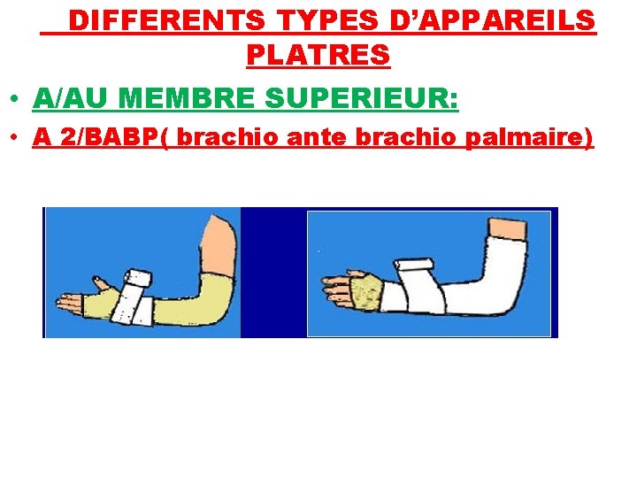 DIFFERENTS TYPES D’APPAREILS PLATRES • A/AU MEMBRE SUPERIEUR: • A 2/BABP( brachio ante brachio