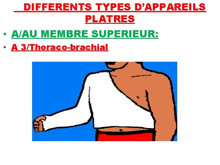 DIFFERENTS TYPES D’APPAREILS PLATRES • A/AU MEMBRE SUPERIEUR: • A 3/Thoraco-brachial 