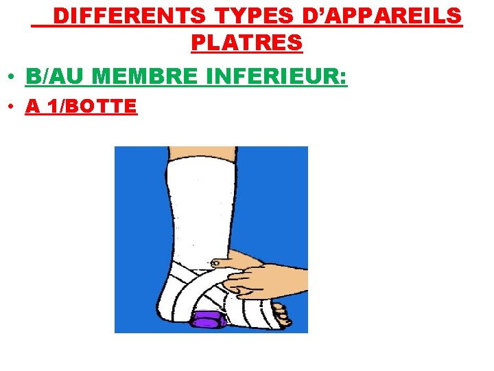 DIFFERENTS TYPES D’APPAREILS PLATRES • B/AU MEMBRE INFERIEUR: • A 1/BOTTE 