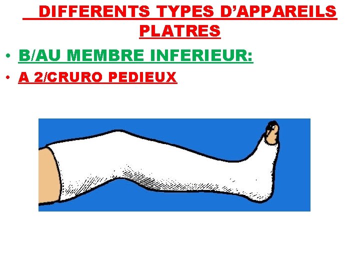 DIFFERENTS TYPES D’APPAREILS PLATRES • B/AU MEMBRE INFERIEUR: • A 2/CRURO PEDIEUX 