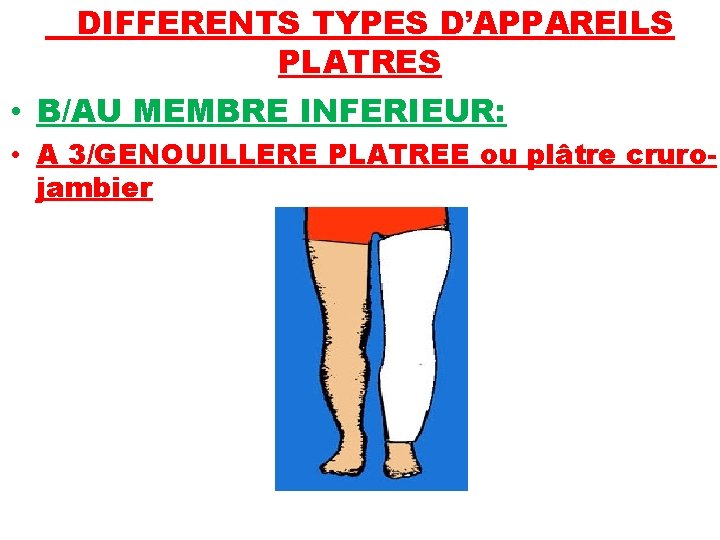 DIFFERENTS TYPES D’APPAREILS PLATRES • B/AU MEMBRE INFERIEUR: • A 3/GENOUILLERE PLATREE ou plâtre