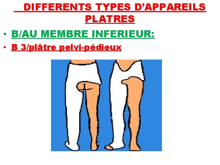 DIFFERENTS TYPES D’APPAREILS PLATRES • B/AU MEMBRE INFERIEUR: • B 3/plâtre pelvi-pédieux 