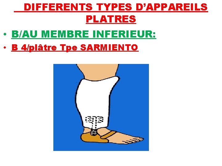 DIFFERENTS TYPES D’APPAREILS PLATRES • B/AU MEMBRE INFERIEUR: • B 4/plâtre Tpe SARMIENTO 