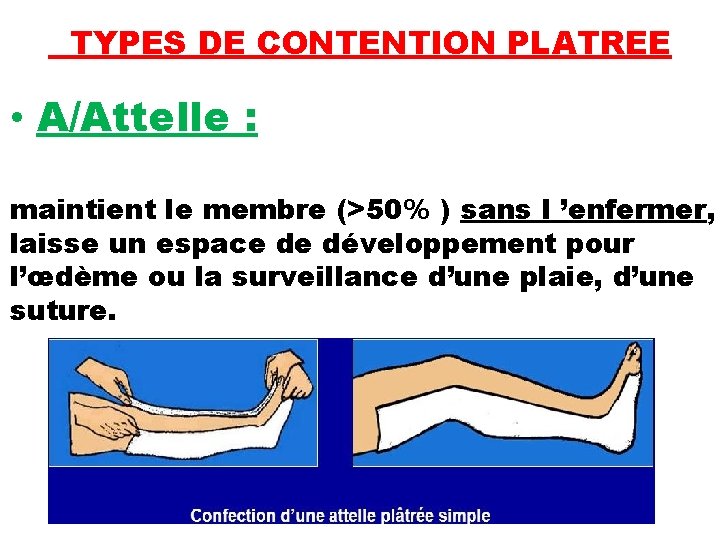 TYPES DE CONTENTION PLATREE • A/Attelle : maintient le membre (>50% ) sans l
