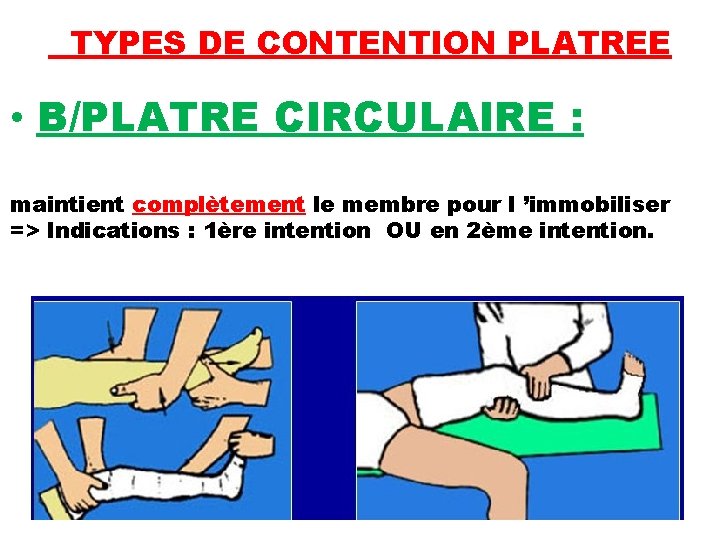 TYPES DE CONTENTION PLATREE • B/PLATRE CIRCULAIRE : maintient complètement le membre pour l