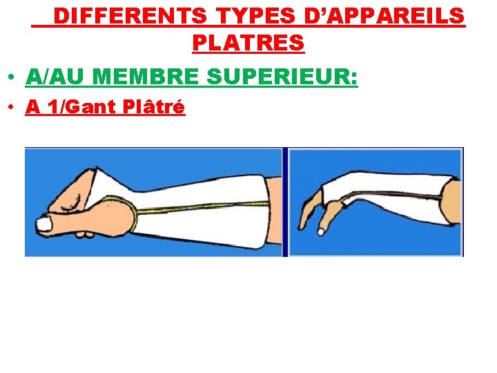 DIFFERENTS TYPES D’APPAREILS PLATRES • A/AU MEMBRE SUPERIEUR: • A 1/Gant Plâtré 