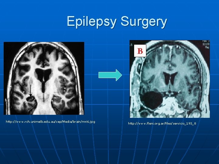 Epilepsy Surgery http: //www. rch. unimelb. edu. au/cep/Media/brain/mri 6. jpg http: //www. fleni. org. Epilepsy Surgery http: //www. rch. unimelb. edu. au/cep/Media/brain/mri 6. jpg http: //www. fleni. org.