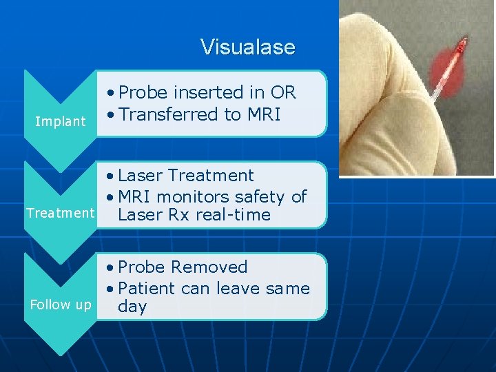 Visualase Implant • Probe inserted in OR • Transferred to MRI Treatment • Laser Visualase Implant • Probe inserted in OR • Transferred to MRI Treatment • Laser