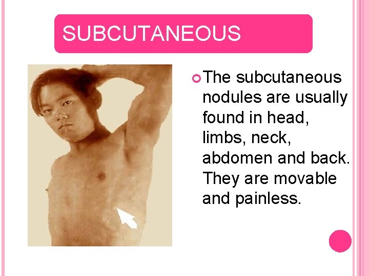 SUBCUTANEOUS The subcutaneous nodules are usually found in head, limbs, neck, abdomen and back.