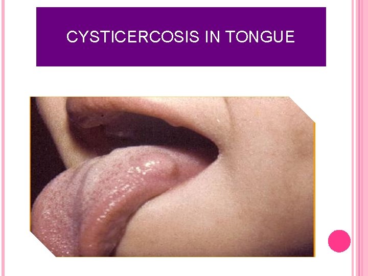 CYSTICERCOSIS IN TONGUE 16 