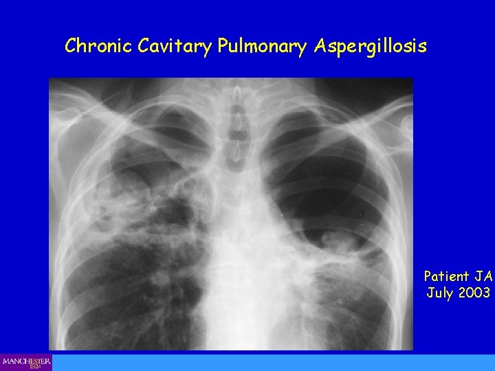 Chronic Cavitary Pulmonary Aspergillosis Patient JA July 2003 