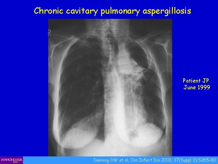 Chronic cavitary pulmonary aspergillosis Patient JP June 1999 Denning DW et al, Clin Infect