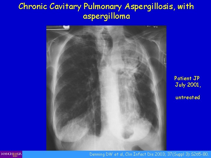 Chronic Cavitary Pulmonary Aspergillosis, with aspergilloma Patient JP July 2001, untreated Denning DW et