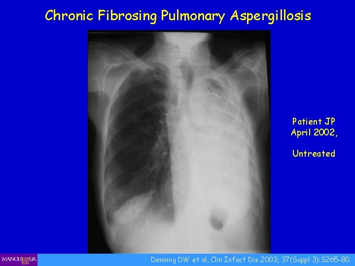Chronic Fibrosing Pulmonary Aspergillosis Patient JP April 2002, Untreated Denning DW et al, Clin