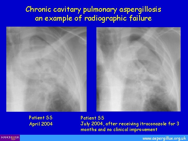 Chronic cavitary pulmonary aspergillosis an example of radiographic failure Patient SS April 2004 Patient