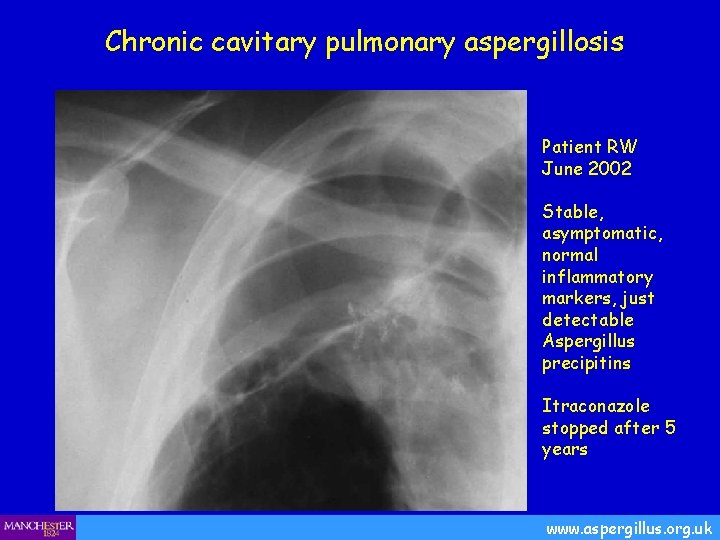 Chronic cavitary pulmonary aspergillosis Patient RW June 2002 Stable, asymptomatic, normal inflammatory markers, just