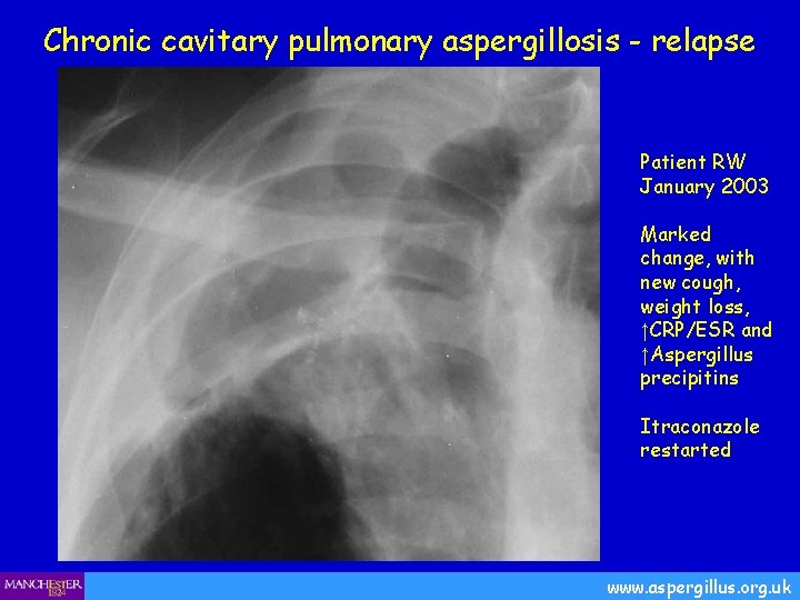 Chronic cavitary pulmonary aspergillosis - relapse Patient RW January 2003 Marked change, with new