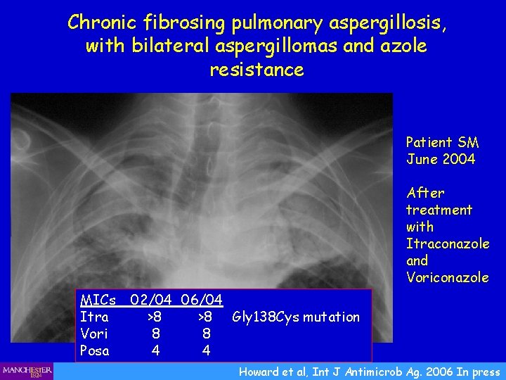 Chronic fibrosing pulmonary aspergillosis, with bilateral aspergillomas and azole resistance Patient SM June 2004