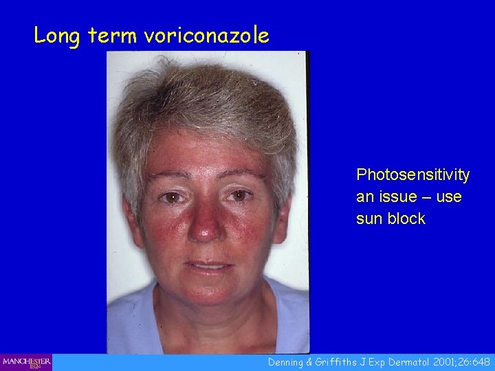 Long term voriconazole Photosensitivity an issue – use sun block Denning & Griffiths J