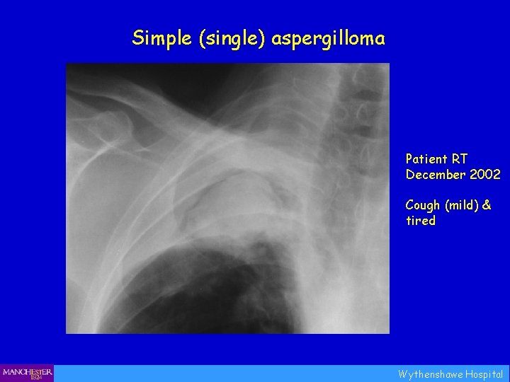 Simple (single) aspergilloma Patient RT December 2002 Cough (mild) & tired Wythenshawe Hospital 