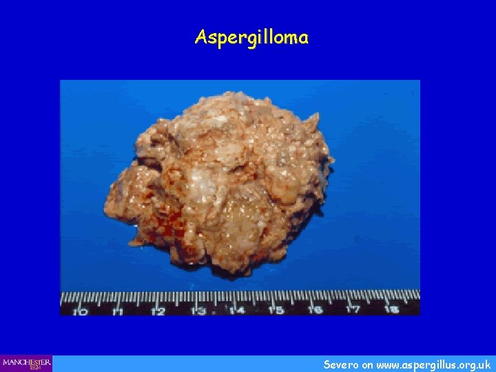 Aspergilloma Severo on www. aspergillus. org. uk 