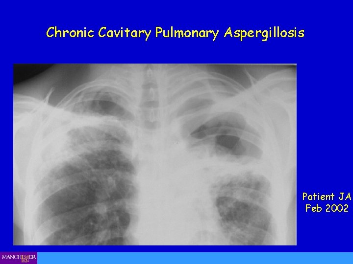 Chronic Cavitary Pulmonary Aspergillosis Patient JA Feb 2002 