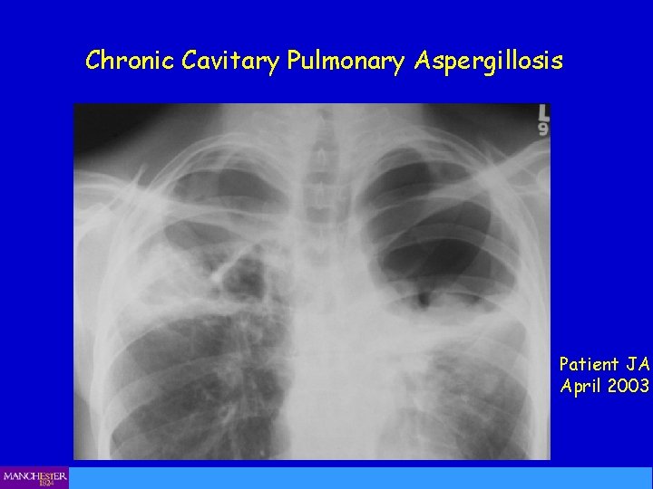 Chronic Cavitary Pulmonary Aspergillosis Patient JA April 2003 