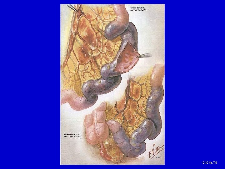 Cl. Chir. TS Cl. Chir. TS