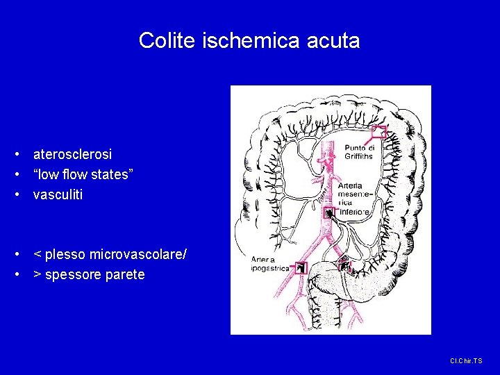 Colite ischemica acuta • aterosclerosi • “low flow states” • vasculiti • < plesso