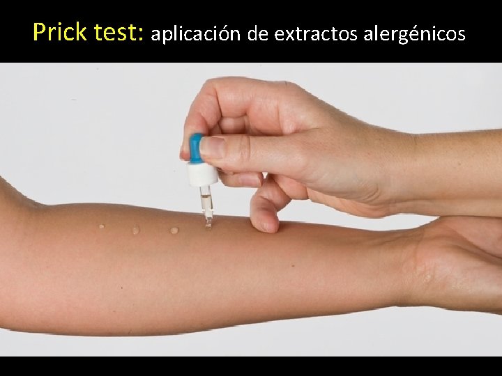 Prick test: aplicación de extractos alergénicos 