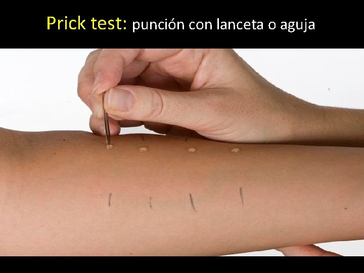 Prick test: punción con lanceta o aguja 