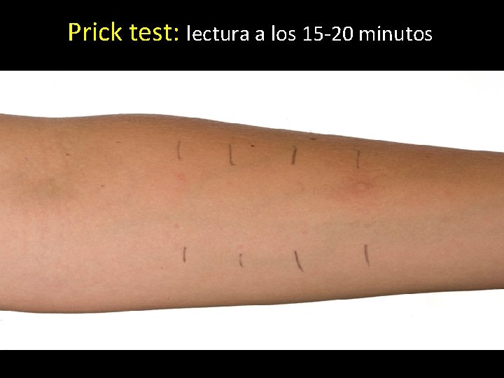 Prick test: lectura a los 15 -20 minutos 