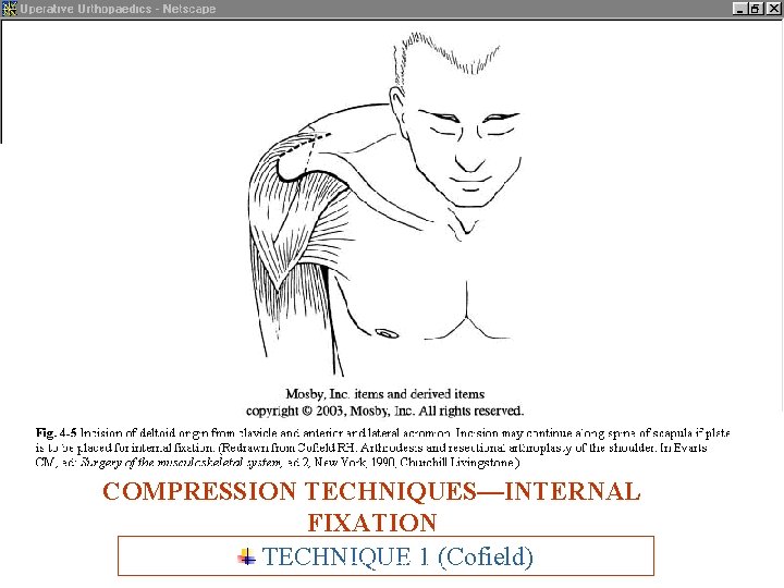 COMPRESSION TECHNIQUES—INTERNAL FIXATION TECHNIQUE 1 (Cofield) ARTHRODESIS 11 