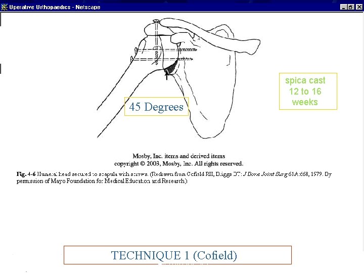 45 Degrees TECHNIQUE 1 (Cofield) ARTHRODESIS spica cast 12 to 16 weeks 12 