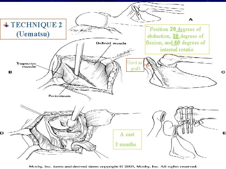 TECHNIQUE 2 (Uematsu) Position 20 degrees of abduction, 30 degrees of flexion, and 40