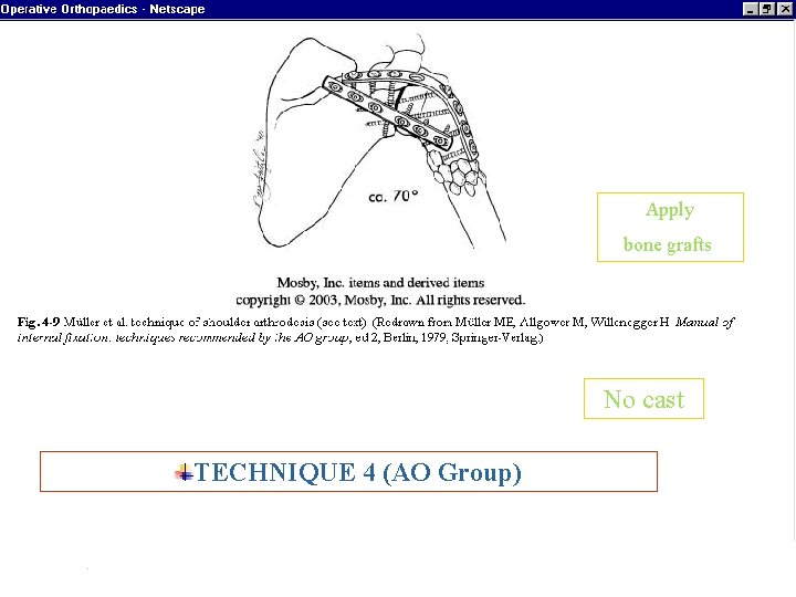 Apply bone grafts No cast TECHNIQUE 4 (AO Group) ARTHRODESIS 16 